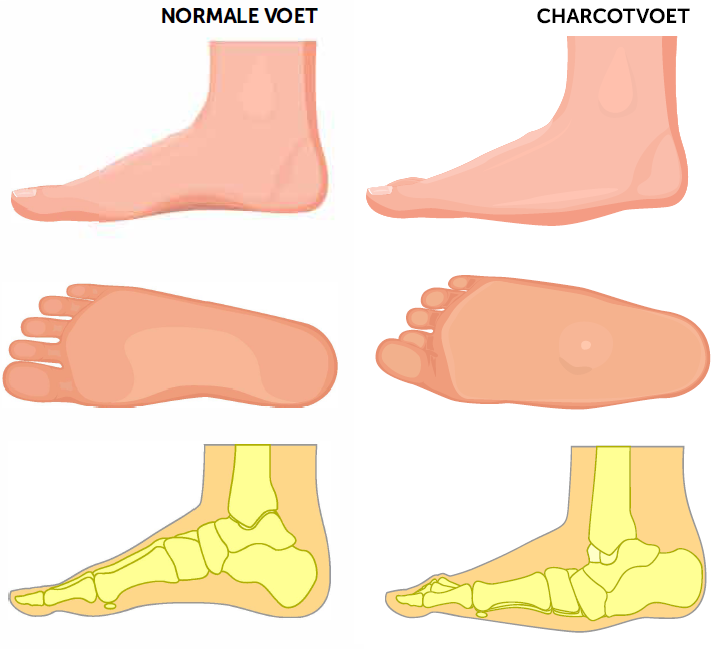 charcot